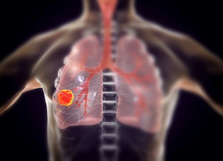 illustrasjon av ikke-småcellet lungekreft
