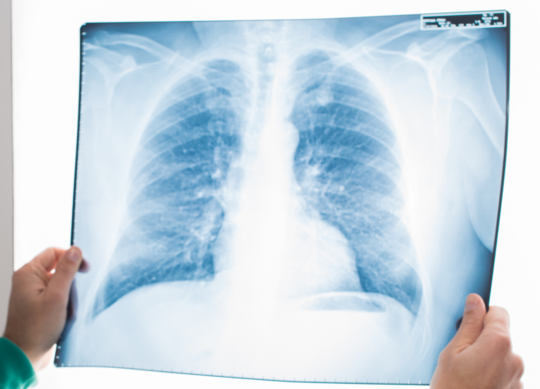 røntgen av lunger
